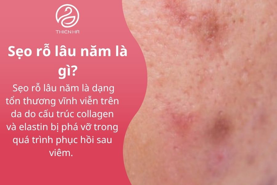 Định nghĩa sẹo rỗ lâu năm.