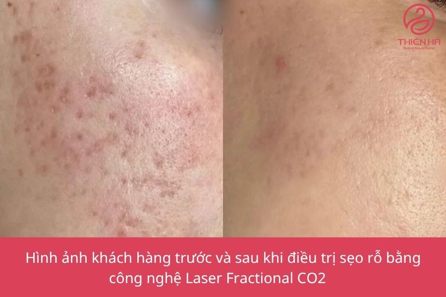 Hình ảnh khách hàng trước và sau khi điều trị sẹo rỗ bằng công nghệ Laser Fractional CO2 