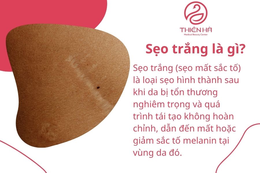 Khái niệm về sẹo trắng