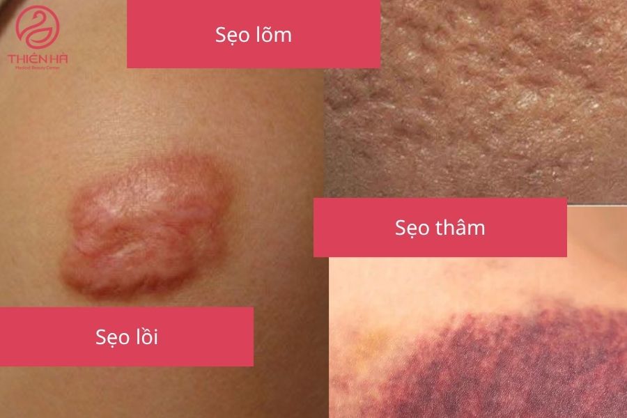 Các loại sẹo thường gặp