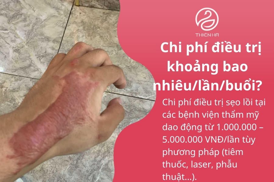 Top 5 bệnh viện thẩm mỹ trị sẹo lồi uy tín hiệu quả cao 5 Một số câu hỏi thường gặp