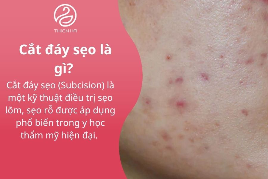 Cắt đáy sẹo: Phương pháp hiệu quả loại bỏ sẹo lõm, sẹo rỗ 1 Cắt đáy sẹo là gì?