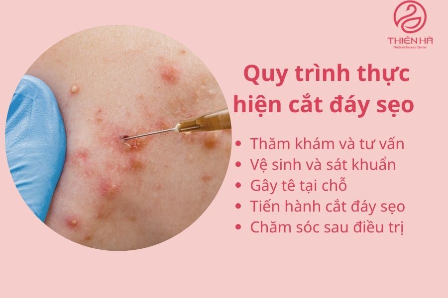 Cắt đáy sẹo: Phương pháp hiệu quả loại bỏ sẹo lõm, sẹo rỗ 3 Quy trình thực hiện cắt đáy sẹo