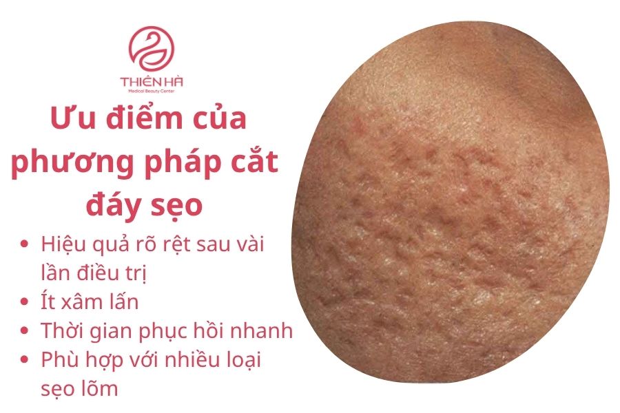 Cắt đáy sẹo: Phương pháp hiệu quả loại bỏ sẹo lõm, sẹo rỗ 2 Ưu điểm của phương pháp cắt đáy sẹo