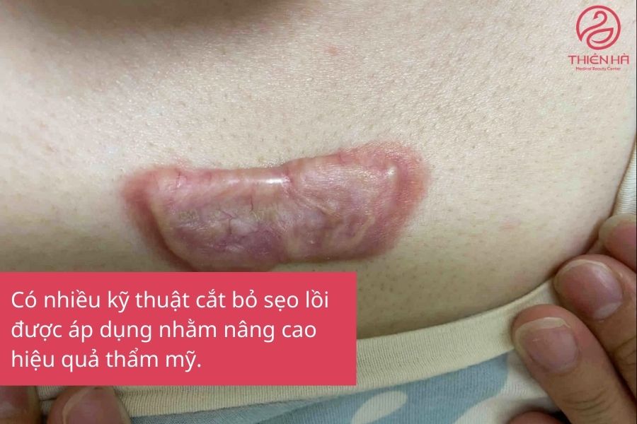 Có nhiều kỹ thuật cắt bỏ sẹo lồi khác nhau 