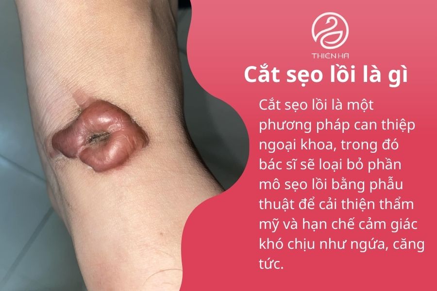Khái niệm về cắt sẹo lồi 