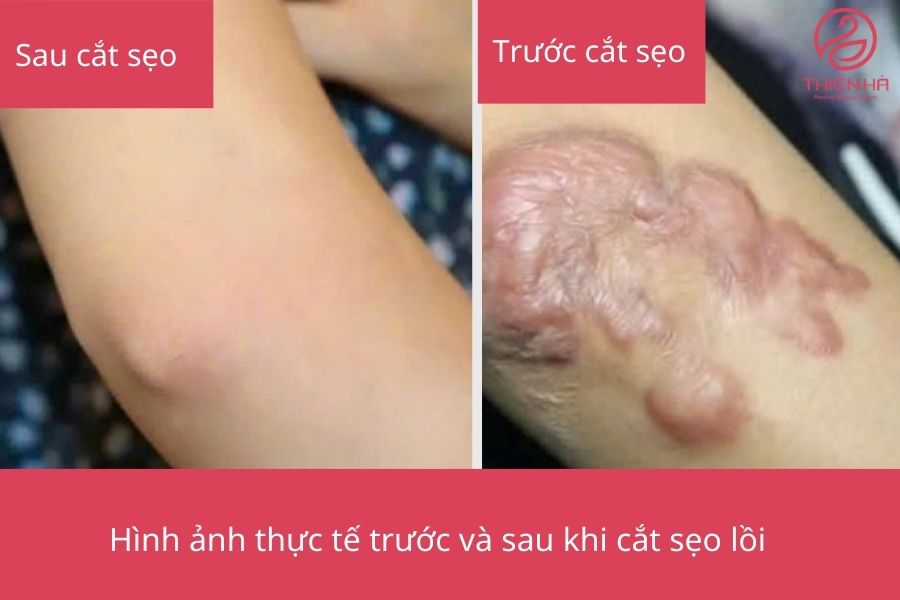 Kết quả cắt trước và sau khi cắt sẹo lồi 