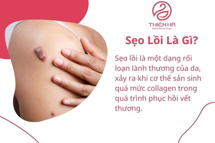 Sẹo Lồi Là Gì?
