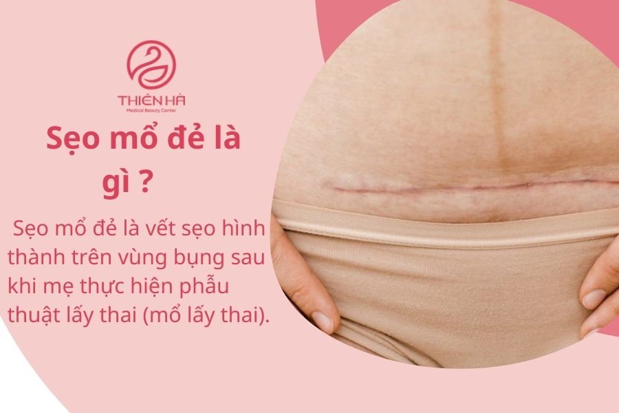 Sẹo mổ đẻ là gì ?