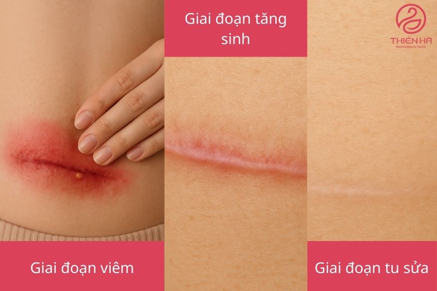 Quá trình hình thành sẹo mổ đẻ