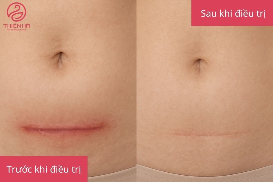 Kết quả sau khi điều trị sẹo mổ đẻ. Vết sẹo mổ đẻ đã mờ đi 