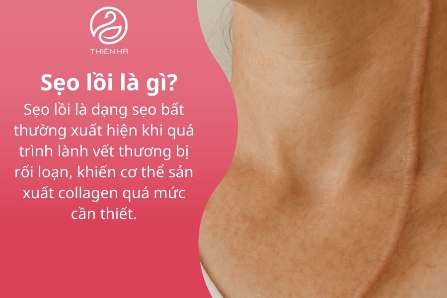Sẹo lồi là gì ? 