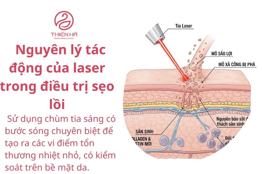 Nguyên lý tác động của laser trong điều trị sẹo lồi