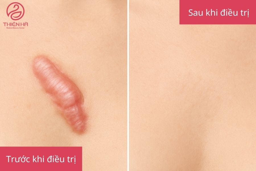 Kết quả sau khi điều trị sẹo lồi bằng laser