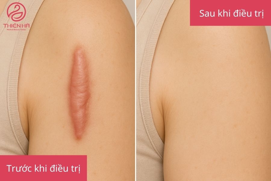 Trị Sẹo Lồi Bằng Laser Giá Bao Nhiêu? Thẩm Mỹ Viện Thiên Hà 7 Kết quả sau điều trị sẹo lồi bằng laser