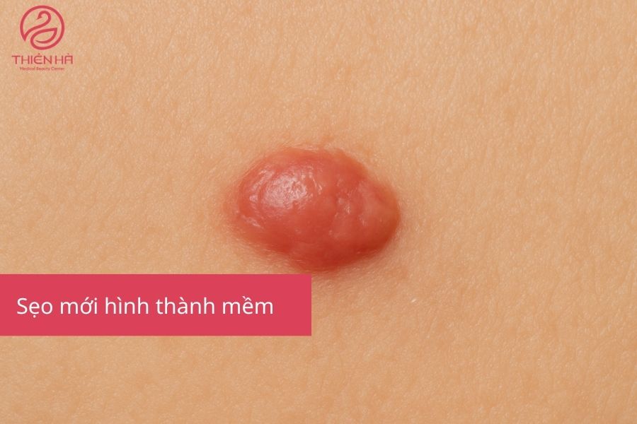 Trị Sẹo Lồi Bằng Laser Giá Bao Nhiêu? Thẩm Mỹ Viện Thiên Hà 4 Sẹo mới hình thành mềm