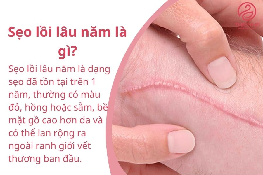 Khái niệm về sẹo lồi lâu năm 