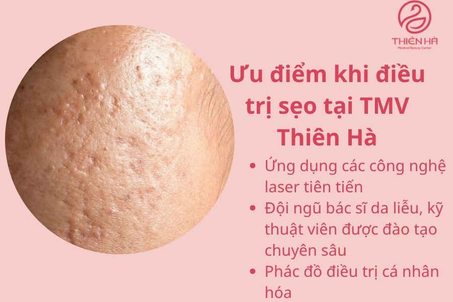 Xóa sẹo bằng laser bao nhiêu tiền? Bảng giá chi tiết tại TMV Thiên Hà 5 Ưu điểm xóa sẹo bằng laser