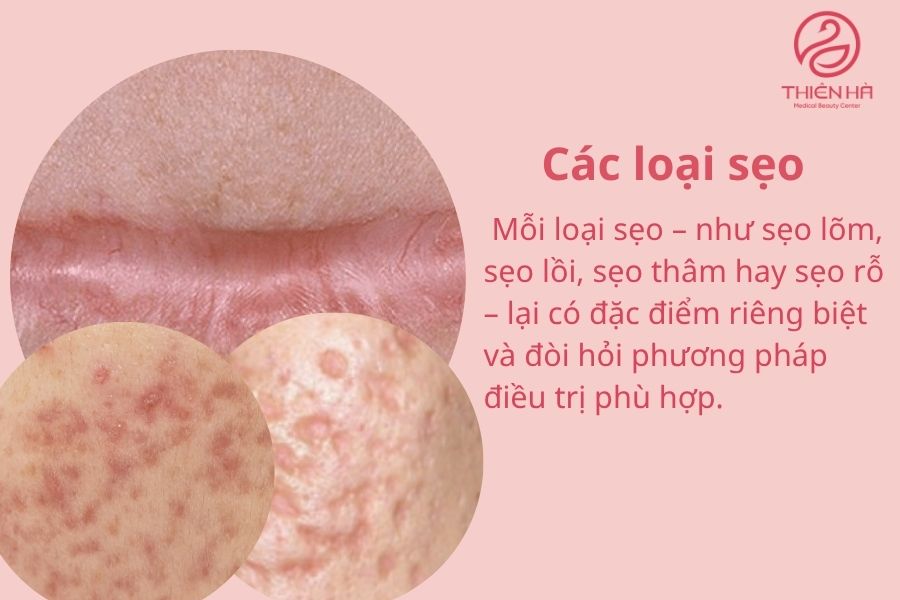 Xóa sẹo bằng laser bao nhiêu tiền? Bảng giá chi tiết tại TMV Thiên Hà 1 Các loại sẹo