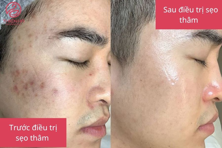 Xóa sẹo lâu năm giá bao nhiêu? Bảng giá chi tiết tại TMV Thiên Hà 2 Hình ảnh trước và sau khi điều trị sẹo thâm