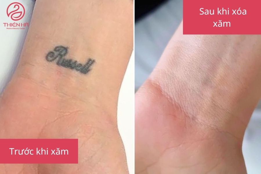 Xóa xăm có để lại sẹo không? Giải đáp chi tiết từ chuyên gia 1 Hình ảnh minh họa trước và sau khi xóa xăm