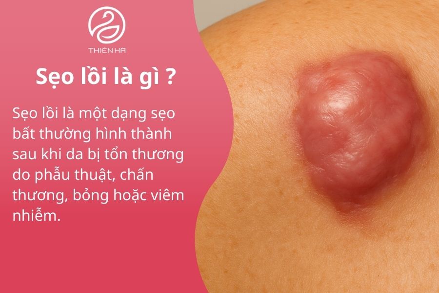 Ăn thịt gà có bị sẹo lồi không? Giải đáp từ chuyên gia tại Thiên Hà 1 Khái niệm về sẹo lồi