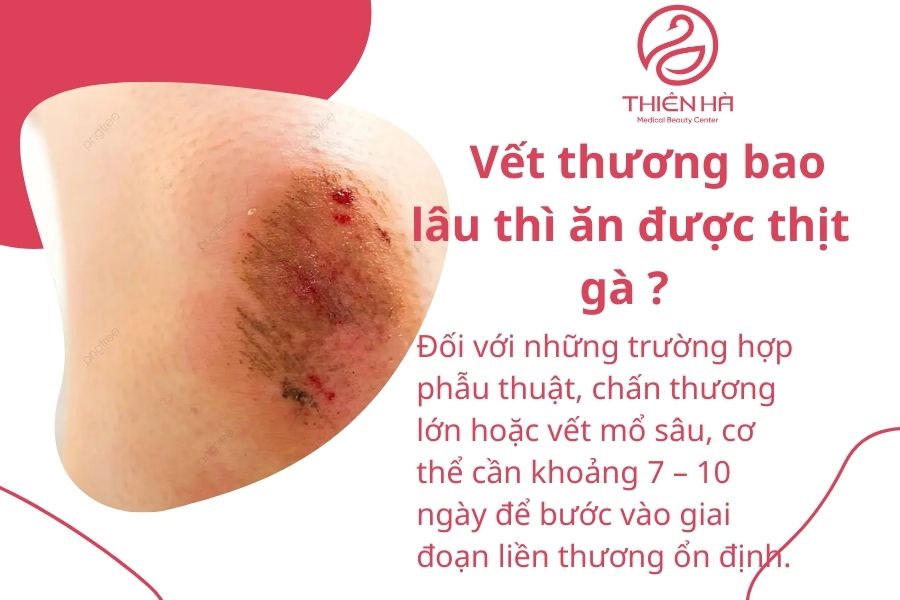 Ăn thịt gà có bị sẹo lồi không? Giải đáp từ chuyên gia tại Thiên Hà 3 Vết thương bao lâu thì ăn được thịt gà ?