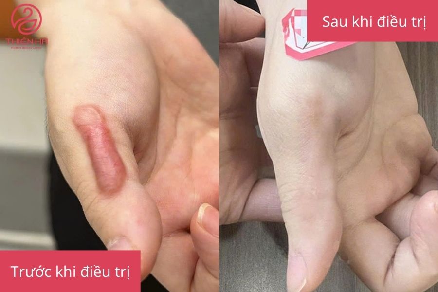 Kết quả sau khi điều trị sẹo lồi 