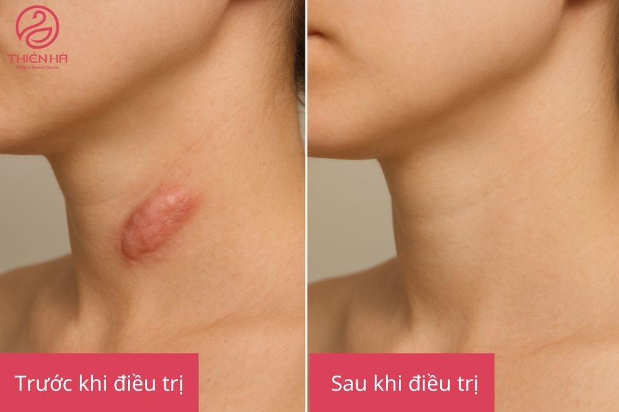 Ăn rau muống có bị sẹo lồi không? Sự thật và cách phòng tránh 1 Kết quả điều trị sẹo lồi