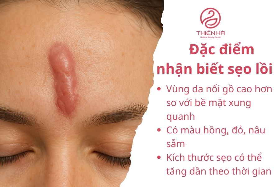 Ăn trứng có bị sẹo lồi không? Sự thật khoa học & lời khuyên từ bác sĩ 1 Đặc điểm nhận biết sẹo lồi