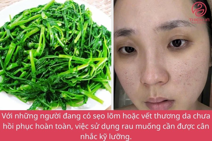 Bị sẹo lõm có nên ăn rau muống không ? Lời khuyên cho người bị sẹo lõm 2 Bị sẹo lõm có nên ăn rau muống không?