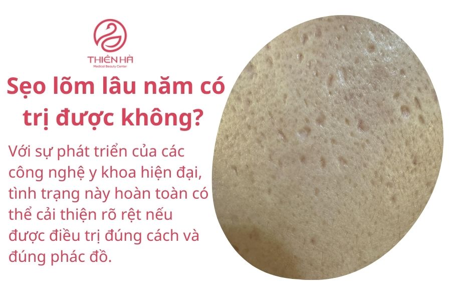 Bị sẹo lõm có nên ăn rau muống không ? Lời khuyên cho người bị sẹo lõm 5 Sẹo lõm lâu năm có trị được không?