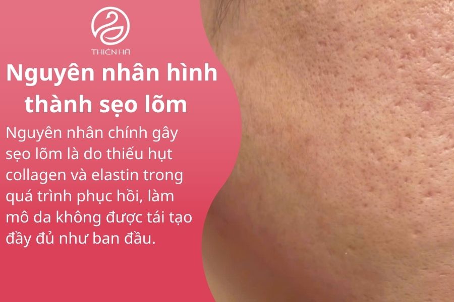 Bị sẹo lõm có nên ăn rau muống không ? Lời khuyên cho người bị sẹo lõm 1 Nguyên nhân hình thành sẹo lõm
