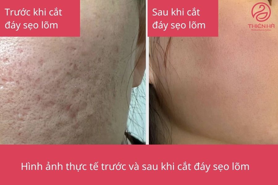 Kết quả sau khi cắt đáy sẹo lõm