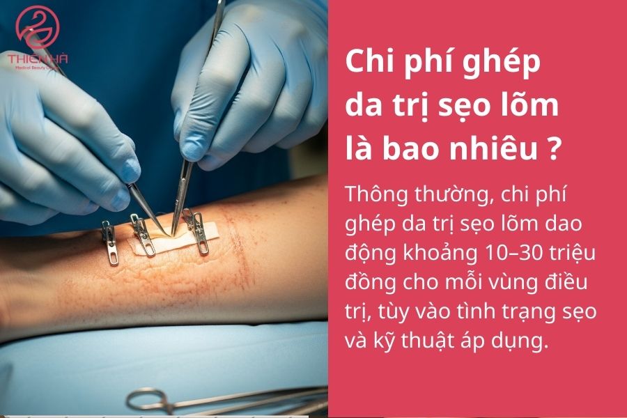 Ghép da trị sẹo lõm - Giải pháp tái tạo da chuyên sâu từ A - Z 4 Chi phí ghép da trị sẹo lõm là bao nhiêu ?