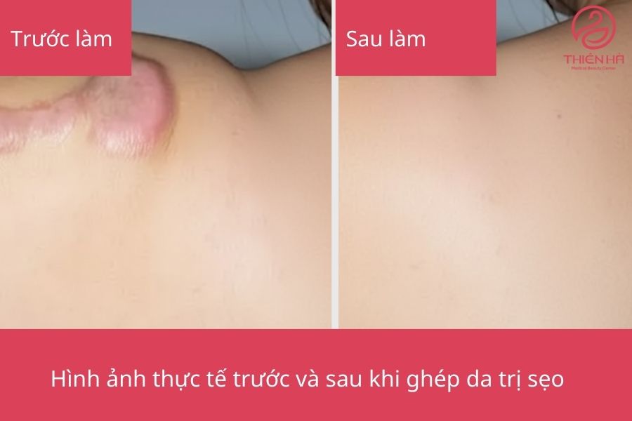 Ghép da trị sẹo lõm - Giải pháp tái tạo da chuyên sâu từ A - Z 2 Kết quả sau thực hiện ghép da trị sẹo