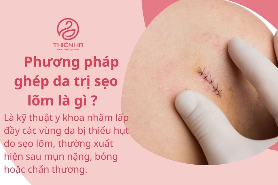 Ghép da trị sẹo lõm - Giải pháp tái tạo da chuyên sâu từ A - Z 1 Ghép da trị sẹo lõm là gì ?