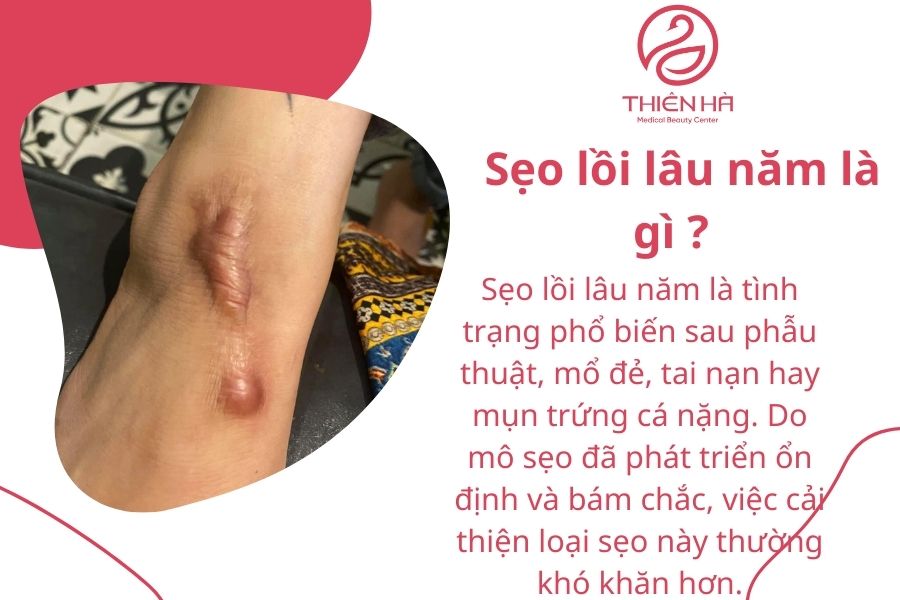Top 7 kem trị sẹo lồi lâu năm hiệu quả bác sĩ khuyên dùng 1 Sẹo lồi lâu năm là gì ?