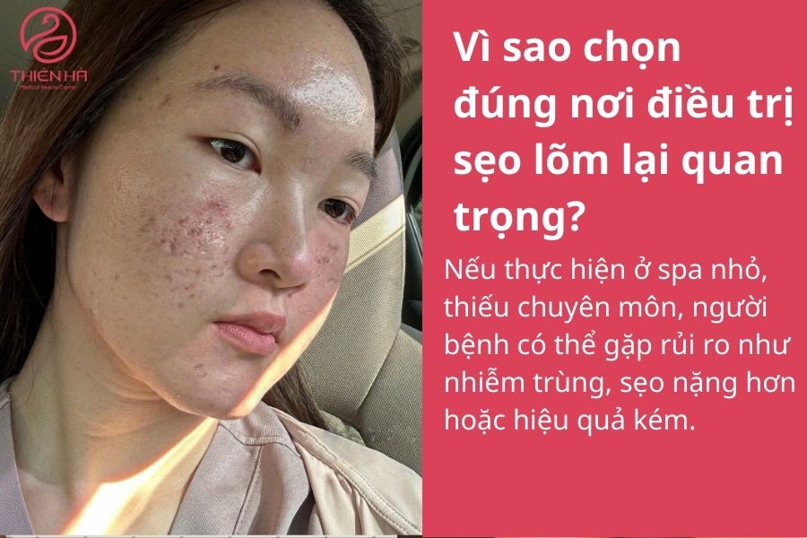 Top 5 nơi điều trị sẹo lõm hiệu quả & uy tín tại Hà Nội 1 Vì sao chọn đúng nơi điều trị sẹo lõm lại quan trọng?