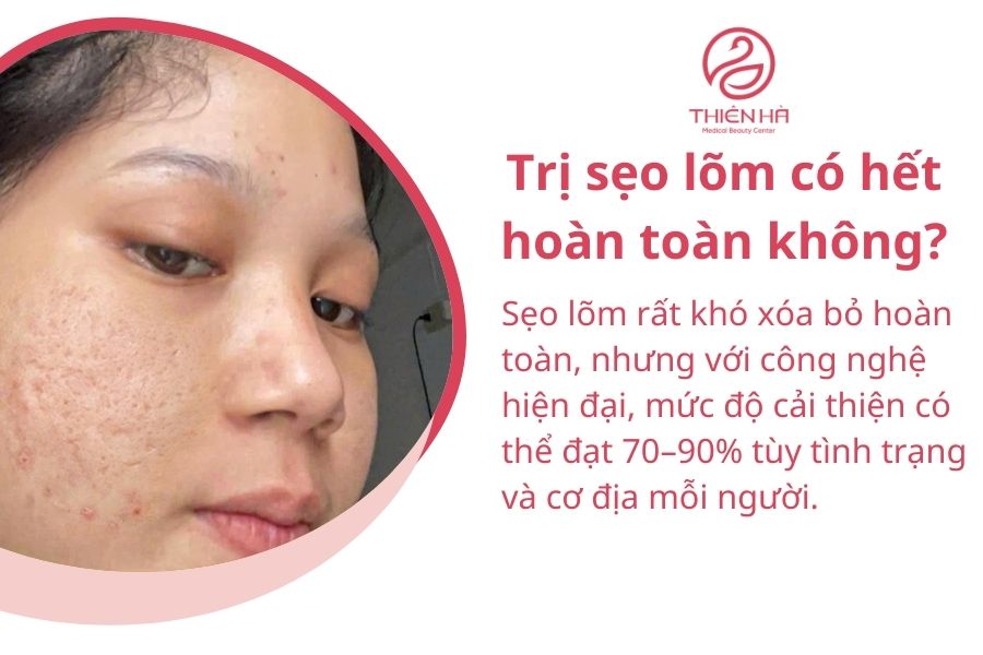 Top 5 nơi điều trị sẹo lõm hiệu quả & uy tín tại Hà Nội 8 Một số câu hỏi thường gặp