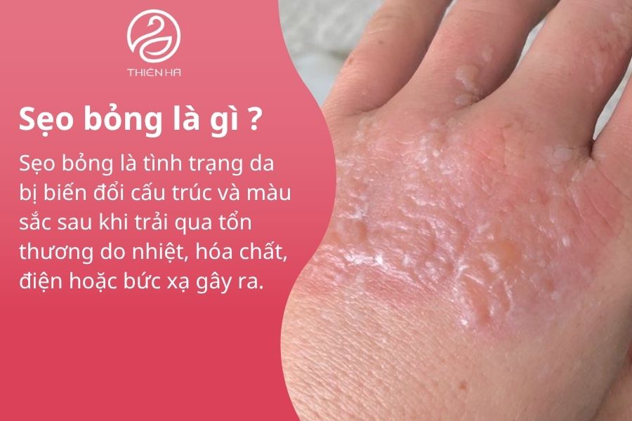 Điều trị sẹo bỏng hiệu quả: từ sơ cứu ban đầu đến công nghệ y khoa 1 Sẹo bỏng là gì ?