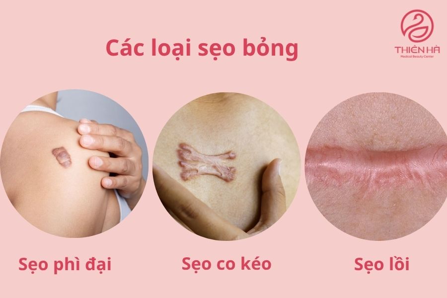 Điều trị sẹo bỏng hiệu quả: từ sơ cứu ban đầu đến công nghệ y khoa 2 Các loại sẹo bỏng