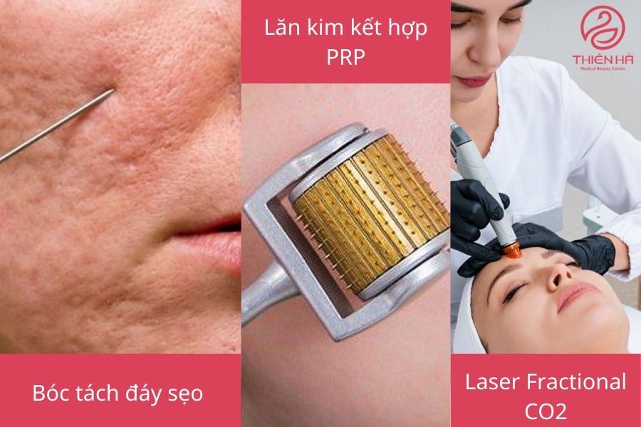 Sẹo lõm: Nguyên nhân, cách điều trị hiệu quả và chi phí cụ thể 4 Các phương pháp điều trị sẹo lõm hiện đại