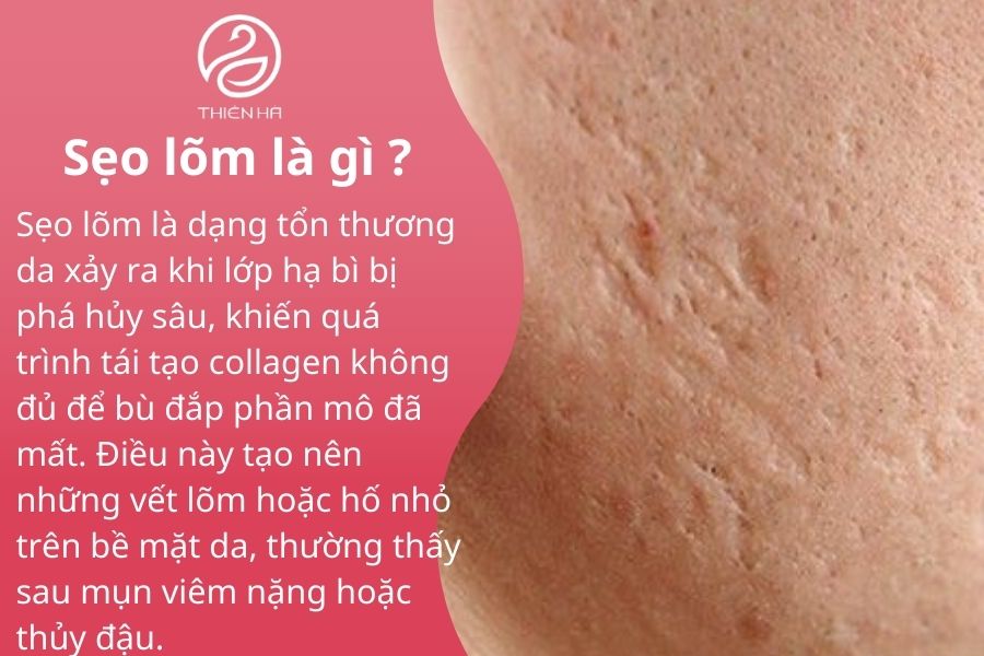 Sẹo lõm: Nguyên nhân, cách điều trị hiệu quả và chi phí cụ thể 1 Khái niệm về sẹo lõm