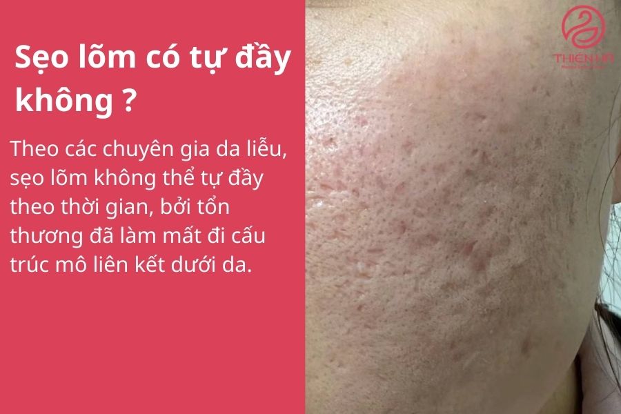 Sẹo lõm: Nguyên nhân, cách điều trị hiệu quả và chi phí cụ thể 3 Sẹo lõm có tự đầy không ? Lời khuyên từ chuyên gia