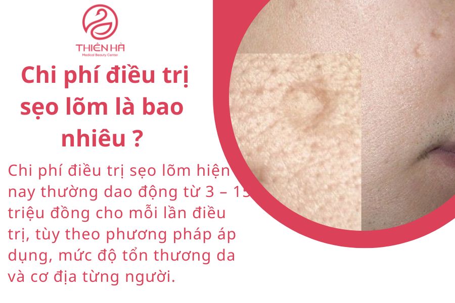 Sẹo lõm: Nguyên nhân, cách điều trị hiệu quả và chi phí cụ thể 5 Chi phí điều trị sẹo lõm là bao nhiêu