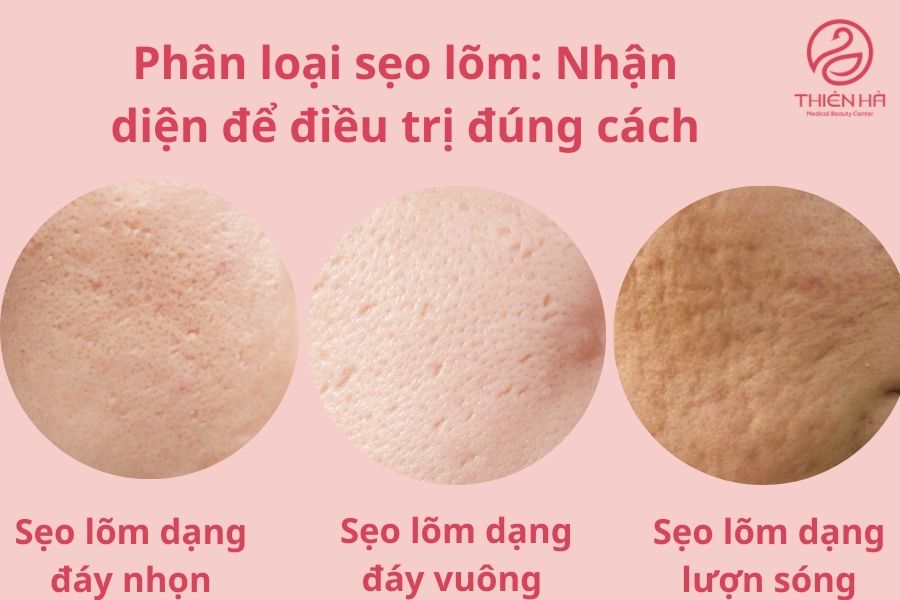 Sẹo lõm: Nguyên nhân, cách điều trị hiệu quả và chi phí cụ thể 2 Các loại sẹo lõm