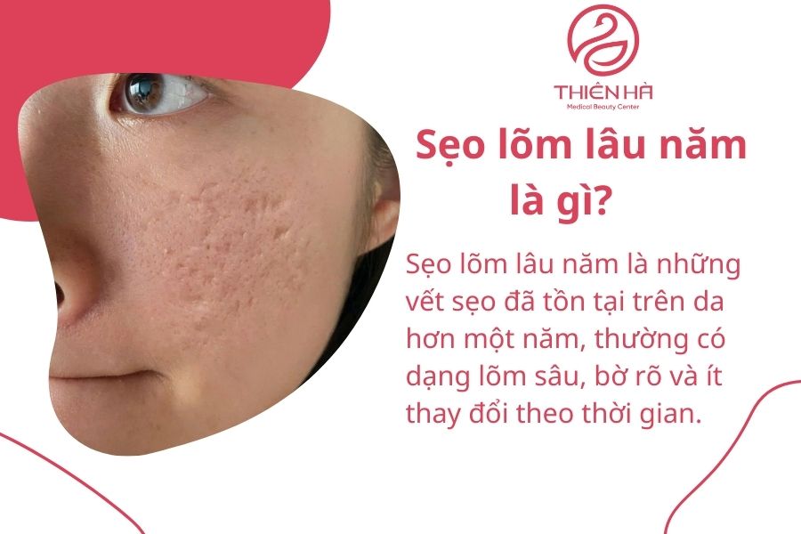 Sẹo lõm lâu năm có trị được không? Quy trình điều trị tại Thiên Hà 1 Sẹo lõm lâu năm là gì?