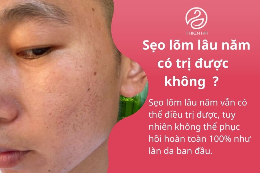 Sẹo lõm lâu năm có trị được không? Quy trình điều trị tại Thiên Hà 2 Sẹo lõm lâu năm có trị được không ?