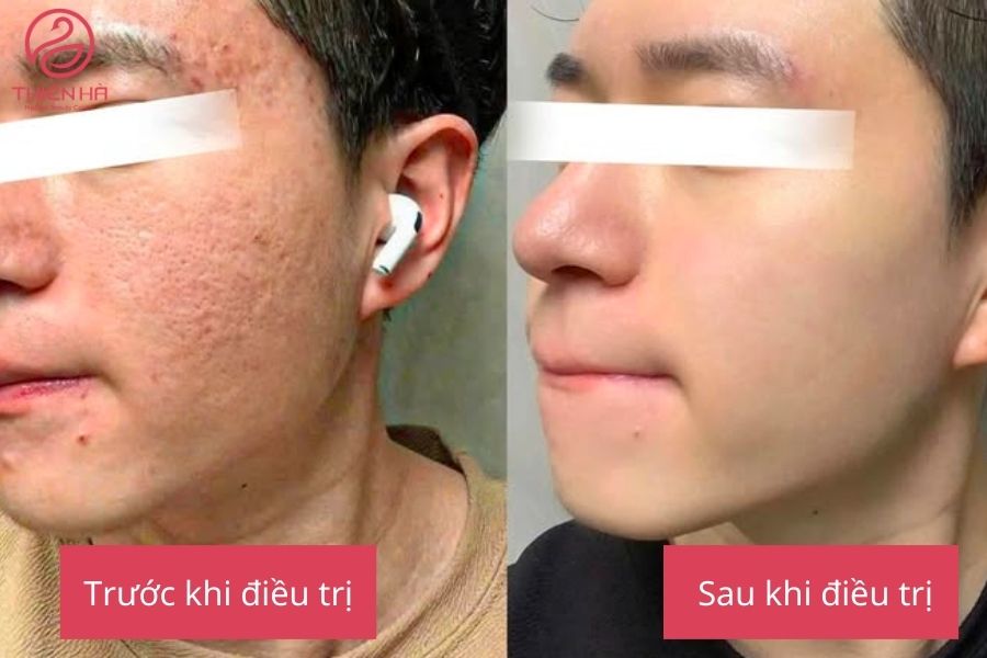 Sẹo lõm lâu năm có trị được không? Quy trình điều trị tại Thiên Hà 4 Hình ảnh thực tế sau khi điều trị sẹo lõm